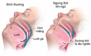 Hội chứng ngưng thở khi ngủ (OSA) do tắc nghẽn đường thở