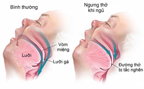 Hội chứng ngưng thở khi ngủ (OSA) do tắc nghẽn đường thở