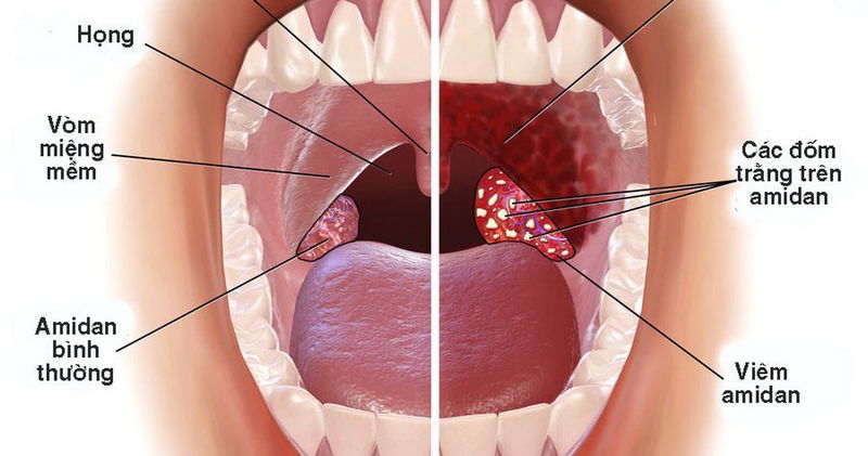Nguyên nhân viêm họng (viêm amidan) tái đi tái lại