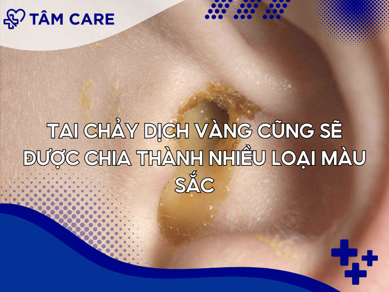 Tai chảy dịch vàng cũng sẽ được chia thành nhiều loại màu sắc