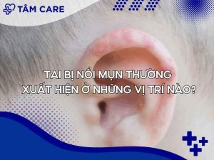 Những vị trí mà tai thường nổi mụn