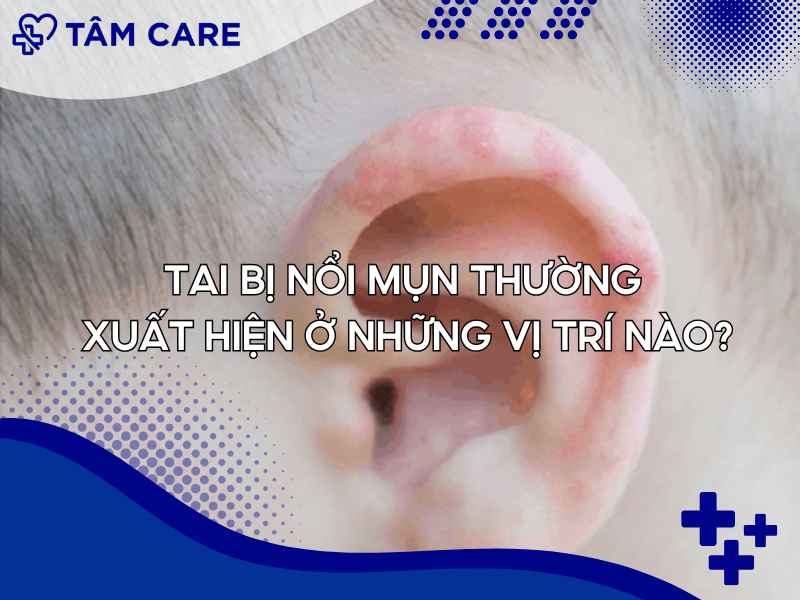 Những vị trí mà tai thường nổi mụn