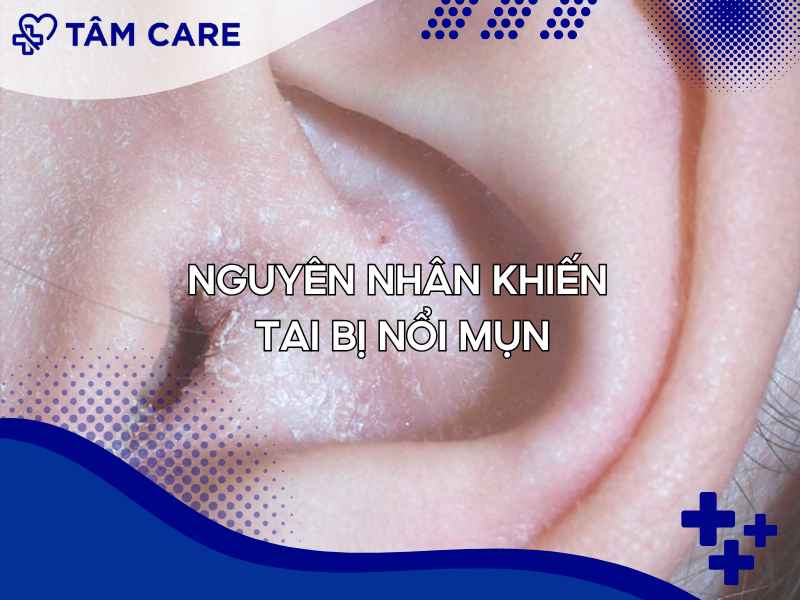 Các nguyên nhân làm cho tai bị nổi mụn