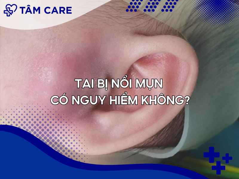 Tai bị nổi mụn có thực sự nguy hiểm ?