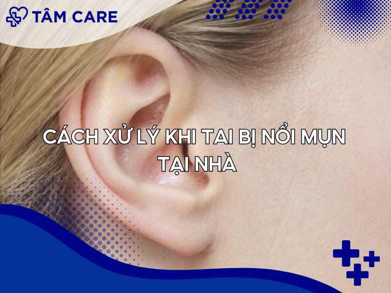 Cách xử lý nhanh khi tai bị nổi mụn tại nhà