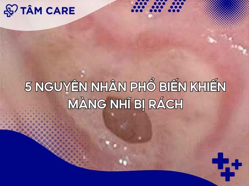 5 Nguyên nhân phổ biến khiến màng nhĩ bị rách