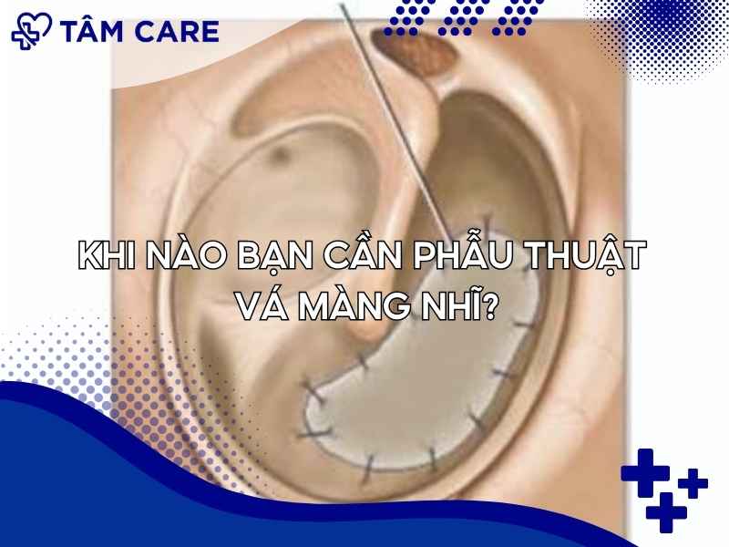Khi nào bạn cần phẫu thuật vá màng nhĩ?