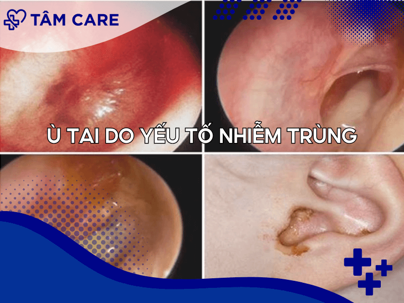 Ù tai do yếu tố nhiễm trùng