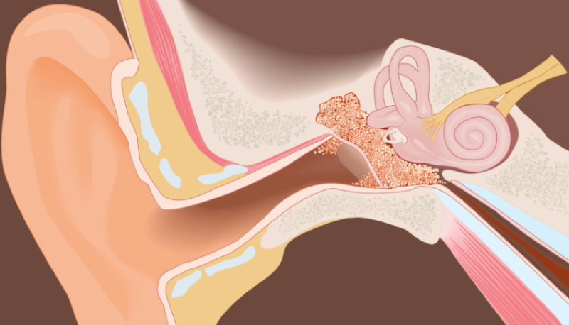Viêm tai giữa cholesteatoma có hai cơ chế là tiên phát và thứ phát