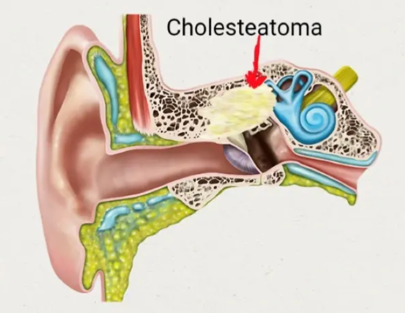 Không phải chảy nước ở tai kéo dài là viêm tai giữa cholesteatoma
