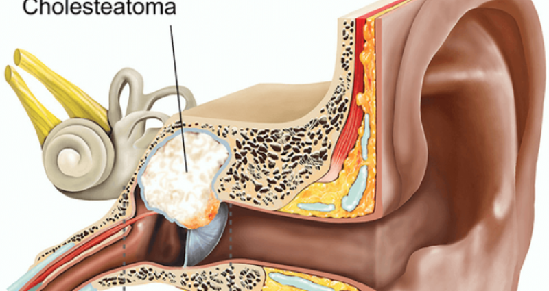 Các phương án điều trị viêm tai giữa cholesteatoma