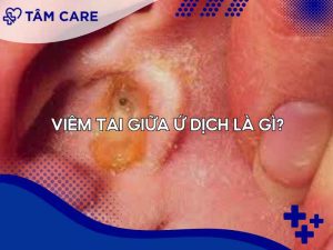 Tổng quan về viêm tai giữa ứ dịch là gì