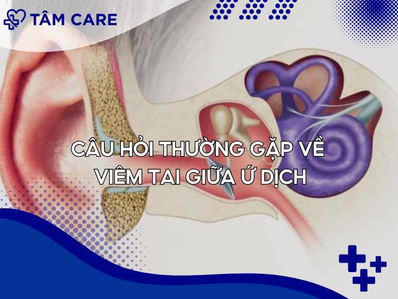 Các câu hỏi thường gặp về viêm tai giữa ứ dịch