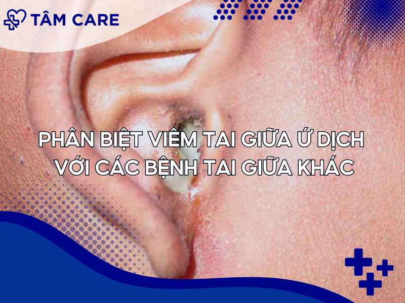 Phân biệt viêm tai ứ dịch cùng các bệnh tai giữa khác