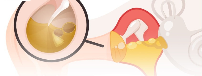 Điều trị viêm tai trong theo nguyên tắc an toàn và thực tế