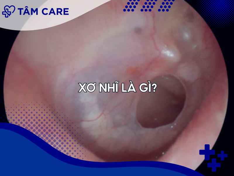 Tổng quan về xơ nhĩ