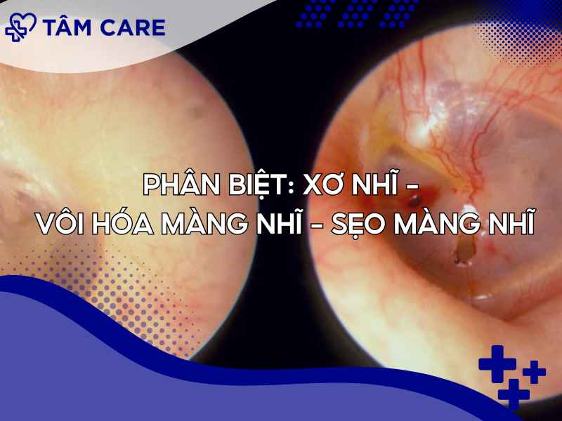 Phân biệt xơ nhĩ, vôi hóa màng nhĩ và sẹo màng nhĩ