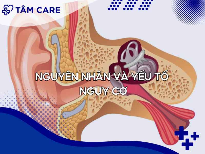 Nguyên nhân và các yếu tố nguy cơ gây xơ nhĩ